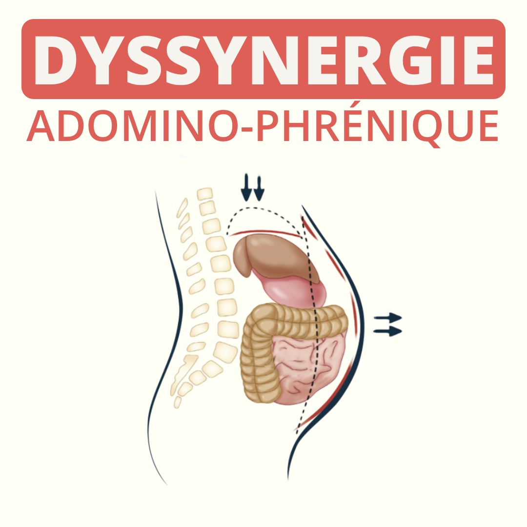 Dyssynergie abdomino-phrénique